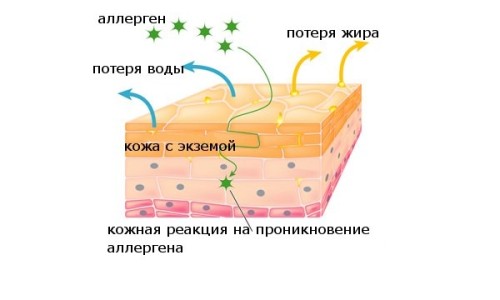 Схема образования аллергической экземы