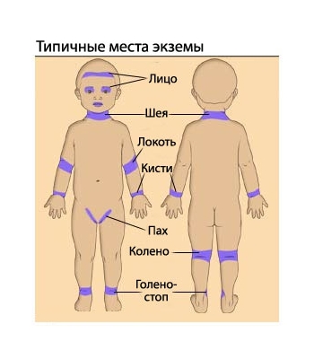 Типичные места проявления экземы