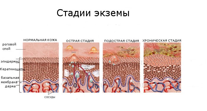 Стадии экземы