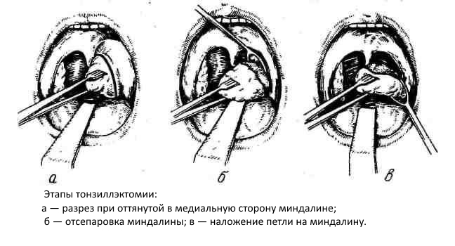 Этапы тонзиллэктомии