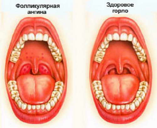 Фолликулярная ангина