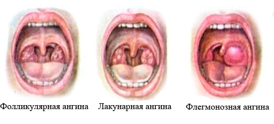 Типы ангины