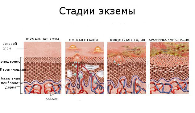 Стадии экземы