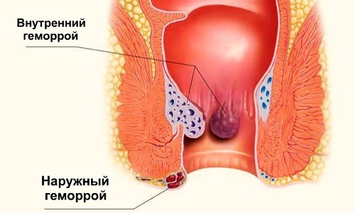 Общий признак геморроя - это появление узлов