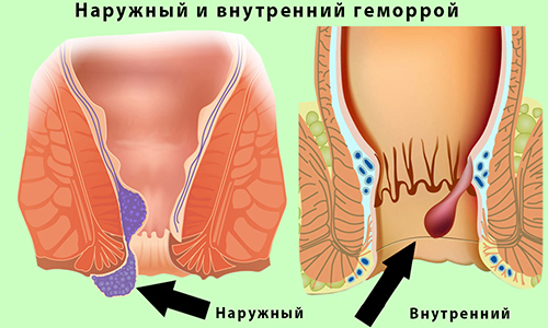 Когда происходит обострение геморроя, важно своевременно принять меры, направленные на уменьшение болевого синдрома