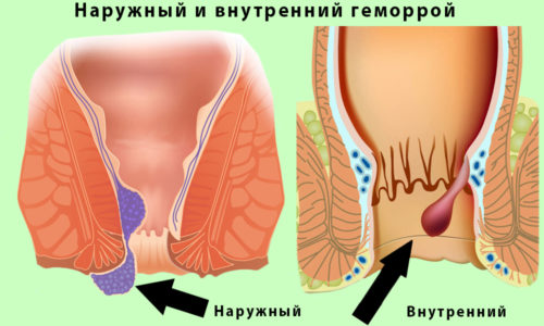 Наружный геморрой от внутреннего отличается расположением геморроидальных узлов