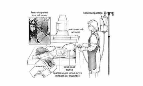 Методы обследования включают ирригоскопию. Процедура безопасная и безболезненная, требует предварительной подготовки, проводится с помощью рентгена