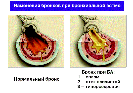 Бронхиальная астма - осложнение аллергии