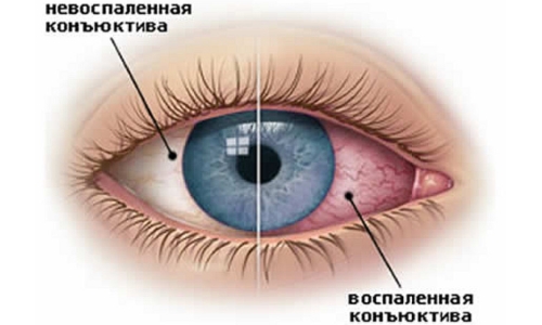 Схема конъюнктивита 