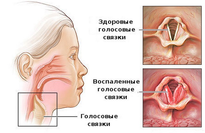 Аллергический ларингит