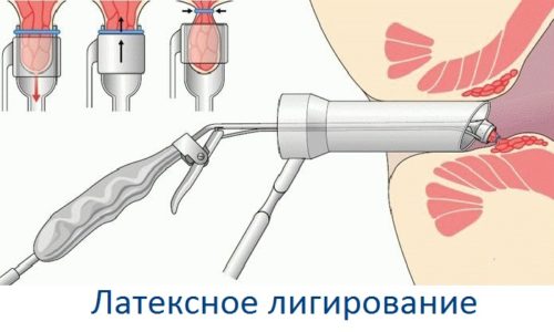 Для лечение геморроя используется перетяжка геморроидальных узлов латексными кольцами (лигирование)