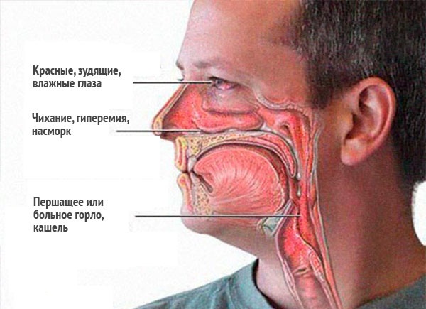 Симптомы отека Квинке