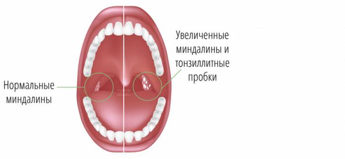 Признаки хронического тонзиллита