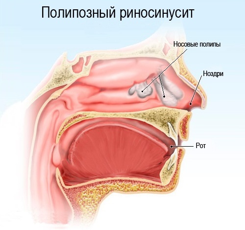 Полипы в носу - причина аллергии