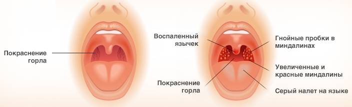 Визуальные признаки тонзиллита