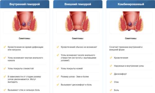 Симптомы внутреннего, наружного и комбинированного геморроя