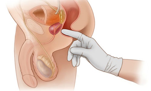 Ручной ректальный массаж специалист проводит указательным пальцем, предварительно надев перчатку и смазав ее вазелином