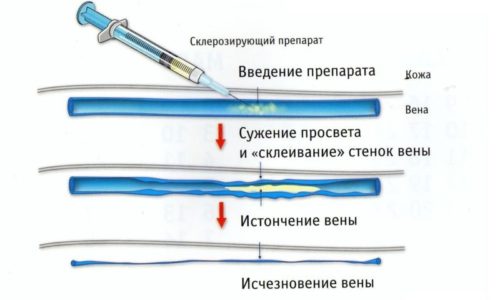 Склеротерапия - это малоинвазивный метод терапии, применяющийся для устранения внутренних геморроидальных узлов на ранних стадиях их развития