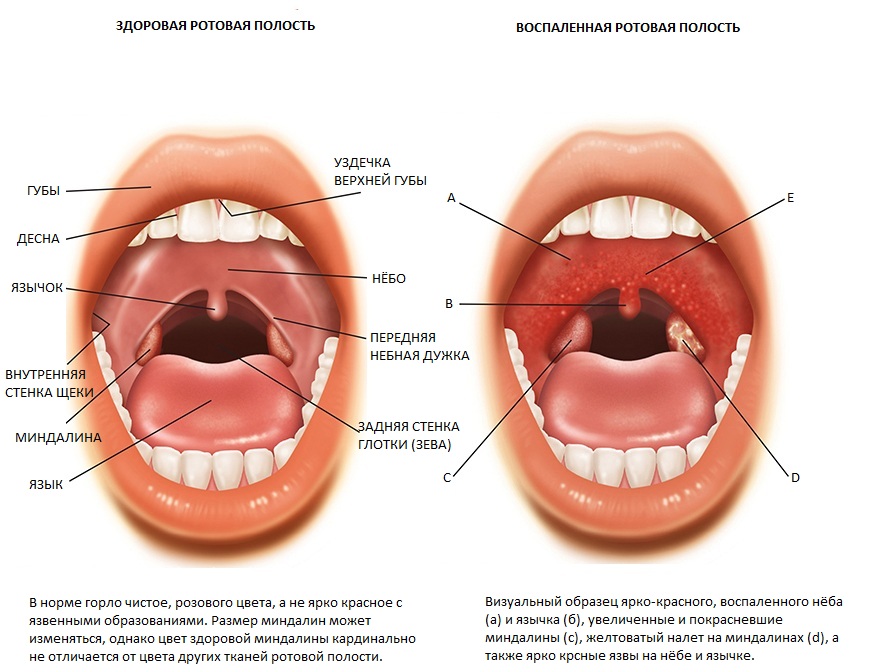 Схема тонзиллита