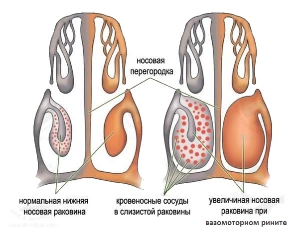 Схема ринита