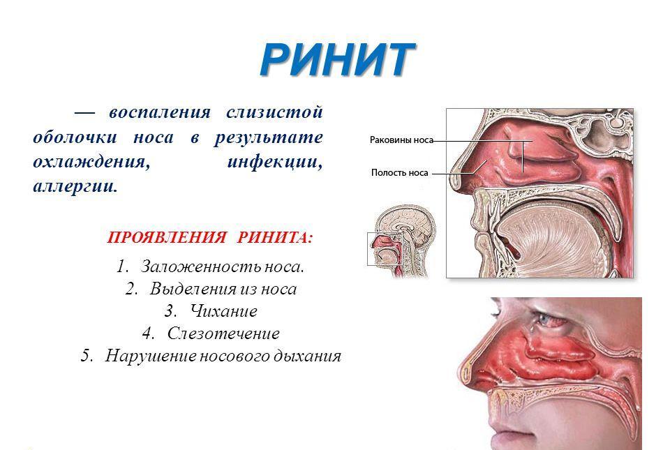 Схема ринита