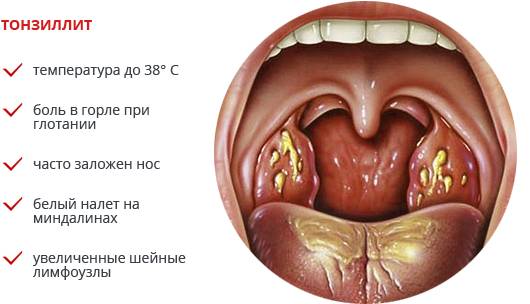 Симптомы тонзиллита