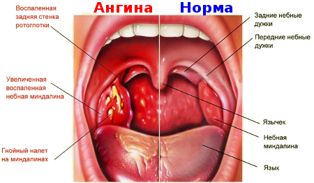 Основные симптомы ангины