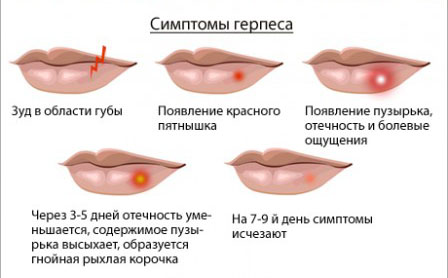 Симптомы герпеса