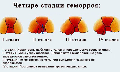 При внутренней форме заболевания формируются узлы, которые невозможно обнаружить при первичном осмотре