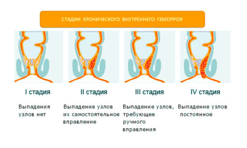 Стадии развития геморроя