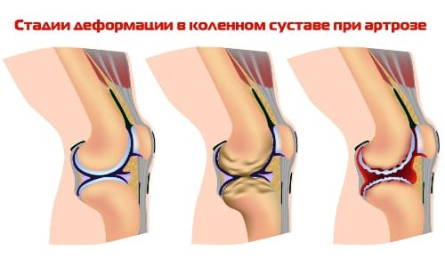 3 стадия геморроя - тяжелая форма расширения геморроидальных вен, при которой появляются внешние и внутренние узлы