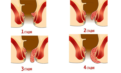 В проктологии выделяется 4 главные стадии развития геморроя