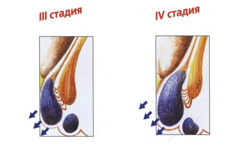 Лазеротерапию на 4 стадии геморроя применяют в исключительных случаях, когда имеются противопоказания к классической геморроидэктомии