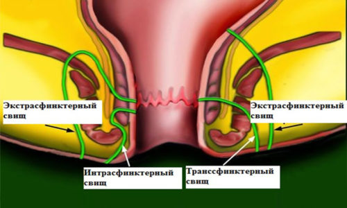 Другим грозным осложнением после проведенной операции в аноректальной зоне считается формирование свищей