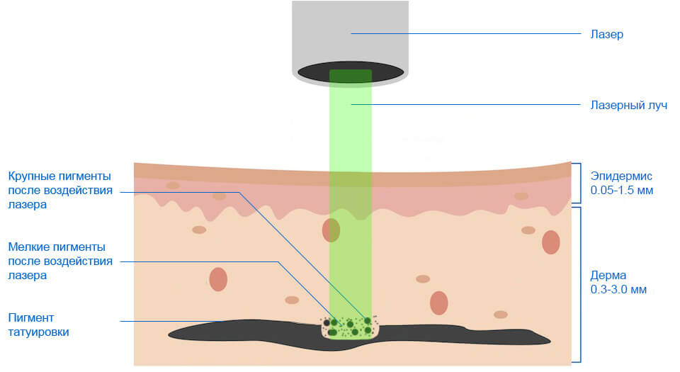Принцип лазерного нанесения татуировки