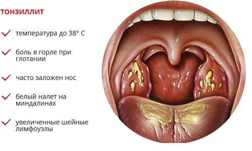 Основные симптомы тонзиллита