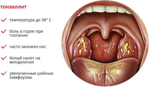 Симптомы тонзиллита