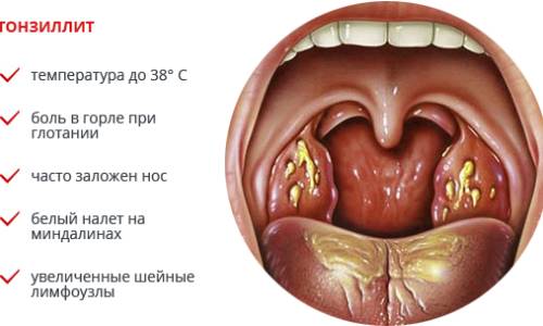 Симптомы тонзиллита