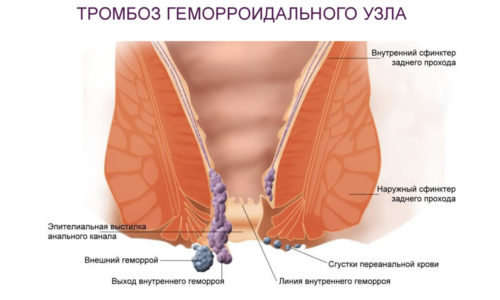 Геморрой с внешними узлами доставляет немало дискомфорта больным и нередко становится причиной развития тяжелых осложнений, вызванных тромбозом пораженных кровеносных сосудов