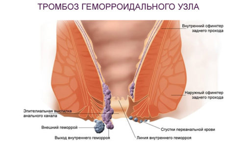 Вовремя не вылеченное воспаление геморроя приводит к тромбозу