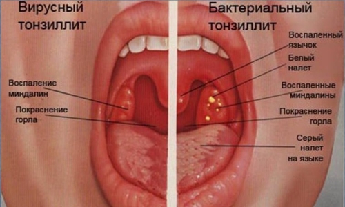 Симптомы вирусного и бактериального тонзиллита