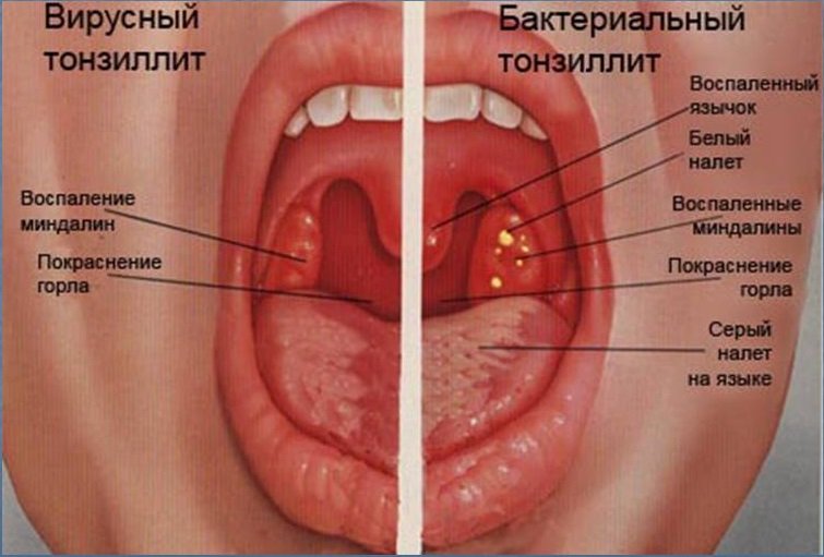 Виды тонзиллита