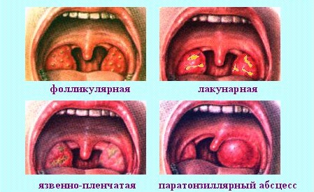 Виды ангины