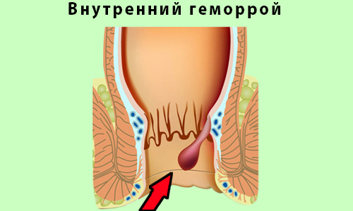 Лигирование кольцами из латекса показано применять при неосложненном внутреннем геморрое 2 и 3 степеней