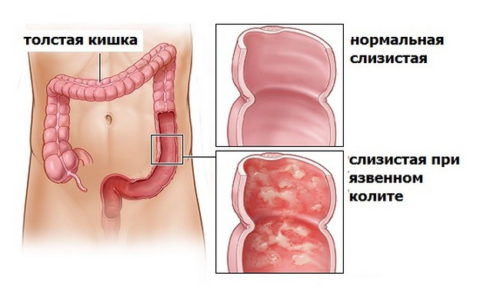 Язвенный колит часто сопутствует геморрою, обострения могут длиться до четырех месяцев